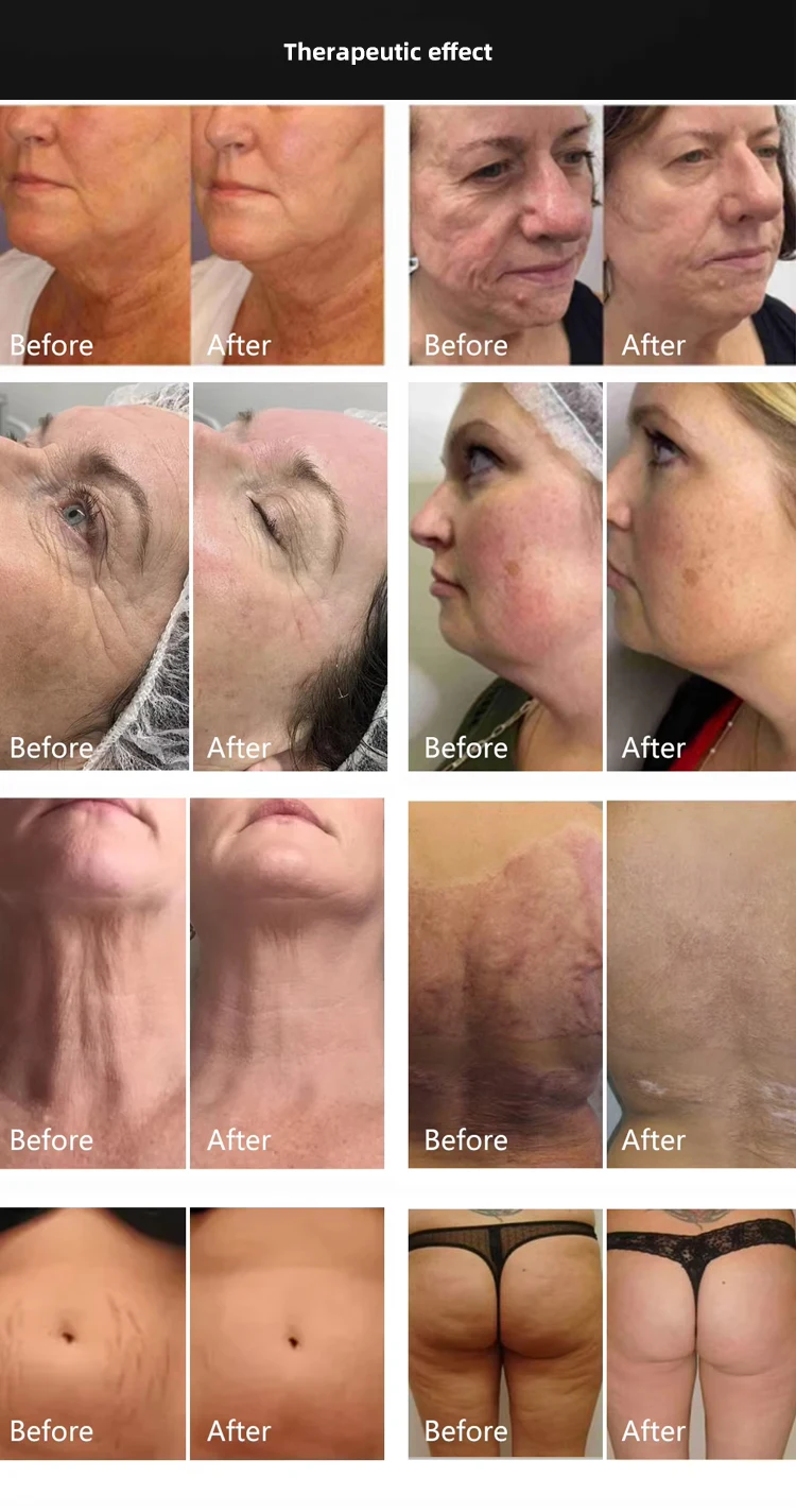 Best Professional Microneedling RF System Device with Ice Hammer 10 Upgrade your aesthetic clinic with a Microneedling RF System featuring Ice Hammer cooling. Combines RF dermal remodeling with post-treatment soothing for faster recovery and superior patient comfort. Best Professional Microneedling RF System Device with Ice Hammer