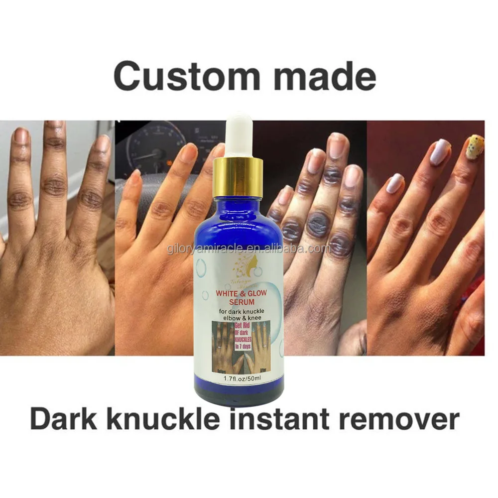 Get Rid Of Dark Knuckles In 7 Days Serum Intense Knuckle Removal Oil For Cleanser Dark Spots 1325