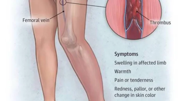 Intermittent DVT Deep Vein Thrombosis Prophylaxis Compression Therapy boots DVT prevention dvt pump machine