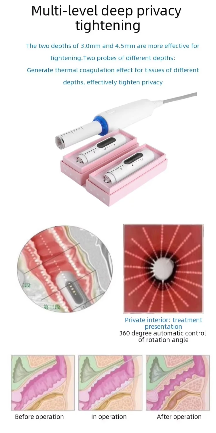 Professional High-Intensity Focused Ultrasound Vaginal Rejuvenation Device 7 Upgrade your clinic with a professional vaginal tightening HIFU machine. Featuring 3.0mm & 4.5mm cartridges for collagen remodeling, интим rejuvenation, and non-invasive tightening treatments. Professional High-Intensity Focused Ultrasound Vaginal Rejuvenation Device