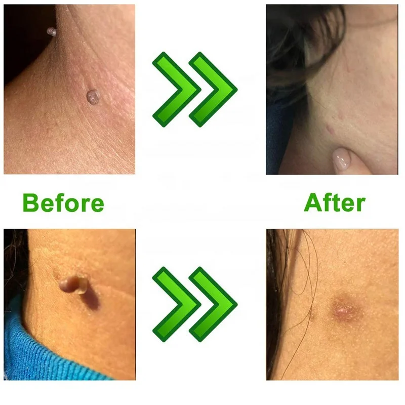Home Use Low Price Skin Tag Remover Kit to Removal Skin Tags Body Effective Mole Wart Removing Skin Tags