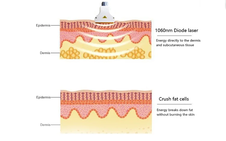 Informative graphic showing how diode laser slimming machine works.