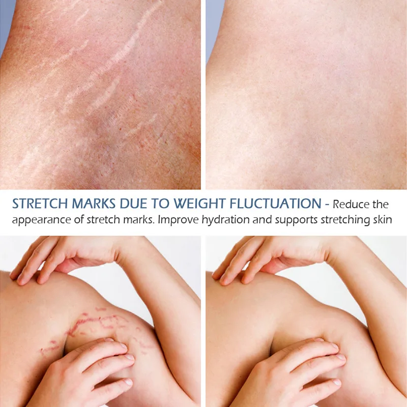 VIBRANT GLAMOUR Effective Anti Stretch Marks Scar Repair Stretch Marks Removal Cream