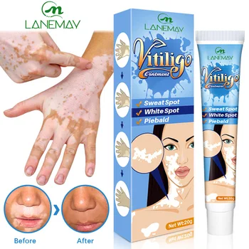 20g Herbal Extract Vitiligo Ointment Remove Ringworm White Spot Removal Skin White Spot Leukoplakia Disease Treatment Cream