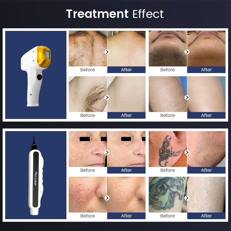 2 In 1 Multifunctional Diode Laser Picosecond Laser Tattoo Removal