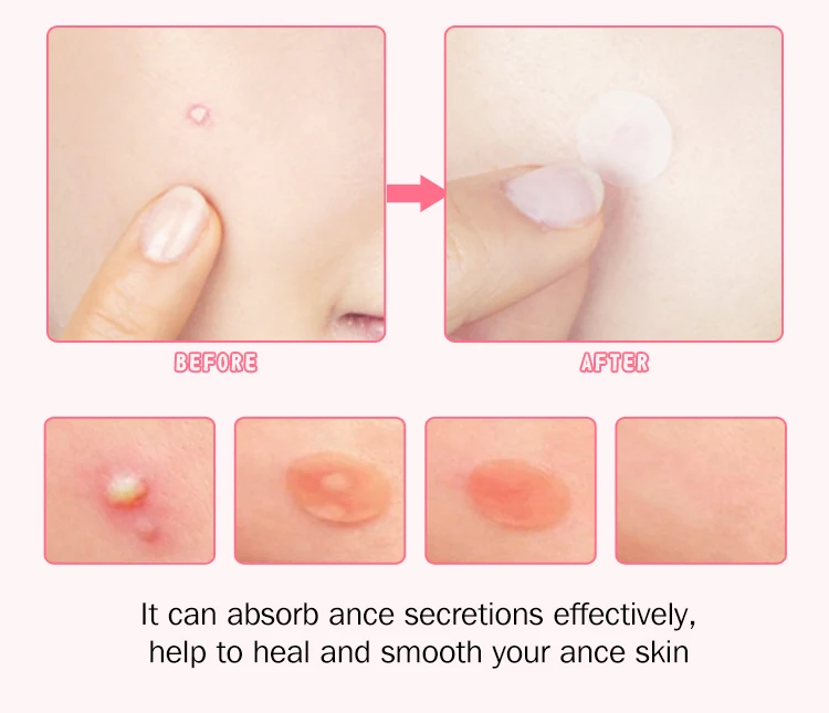 Pimple Patches for Face - Hydrocolloid Acne Treatments
