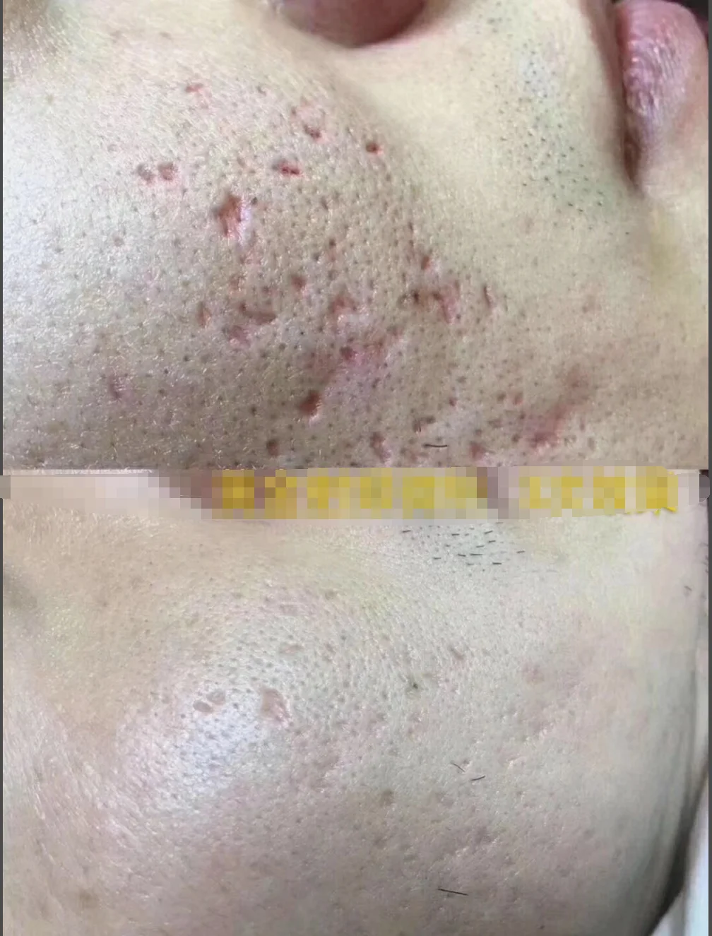 Microneedling Radio Frequency Machine Facial Rf Needle Rf Fractional Micro Needle Disposable Cartridge Fractional Microneedle