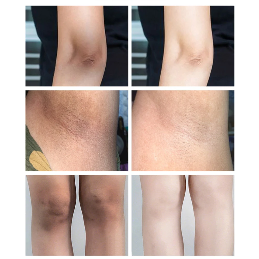 Spring Tree Body and Underarm Lightening Cream Whitening Cream for Dark Skin