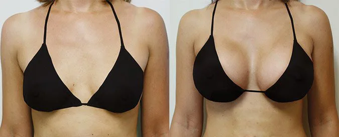 Hereme injectable dermal filler buttock hip breast enlargement injection big brest injection to increase