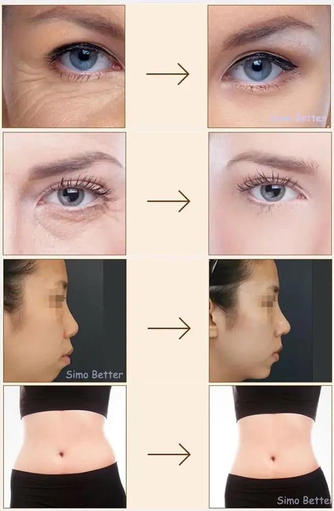 Новая гиалуроновая ручка высокого давления 0 5