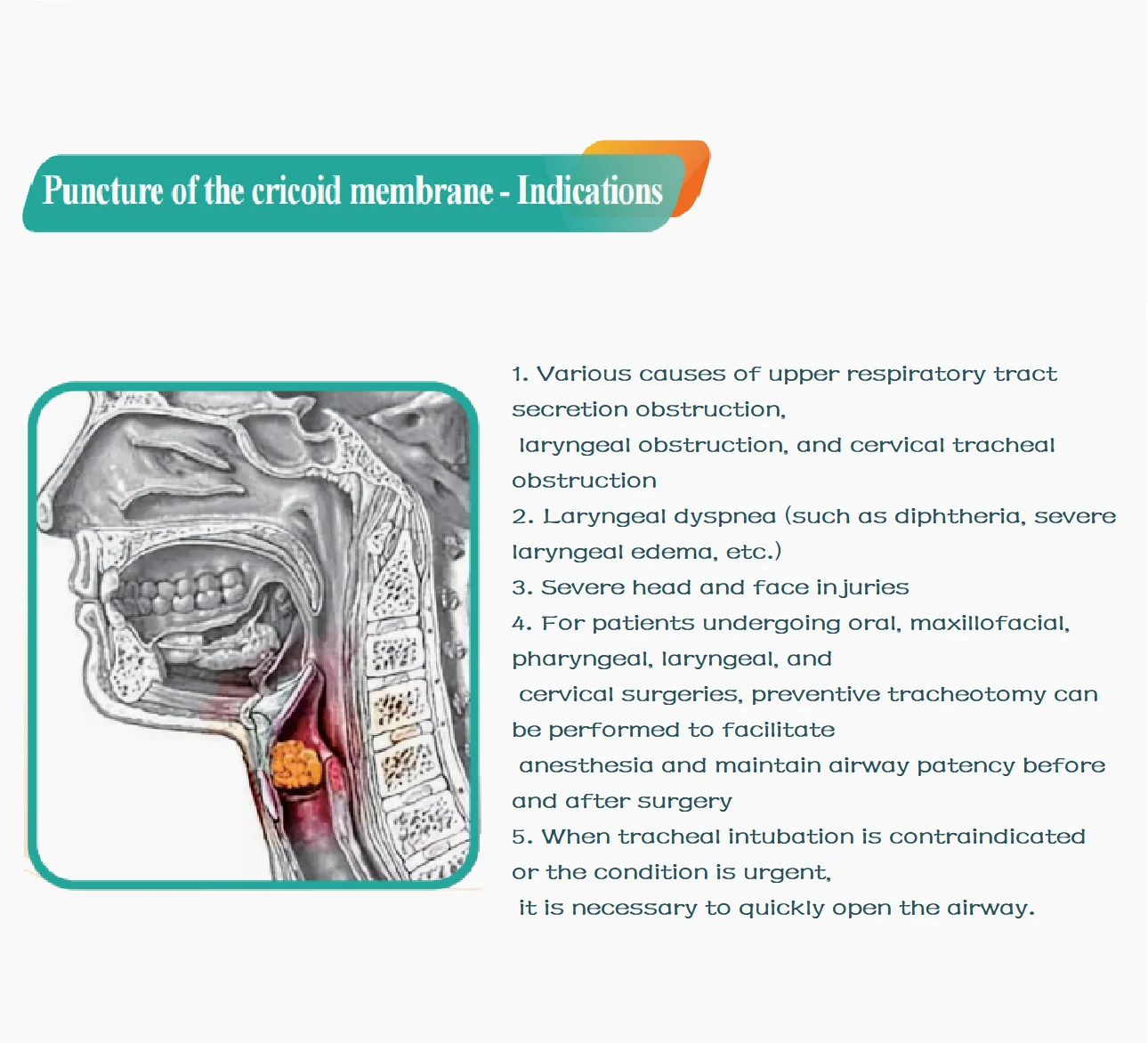 Disposable Cricothyroid membrane puncture kit First Aid supplier