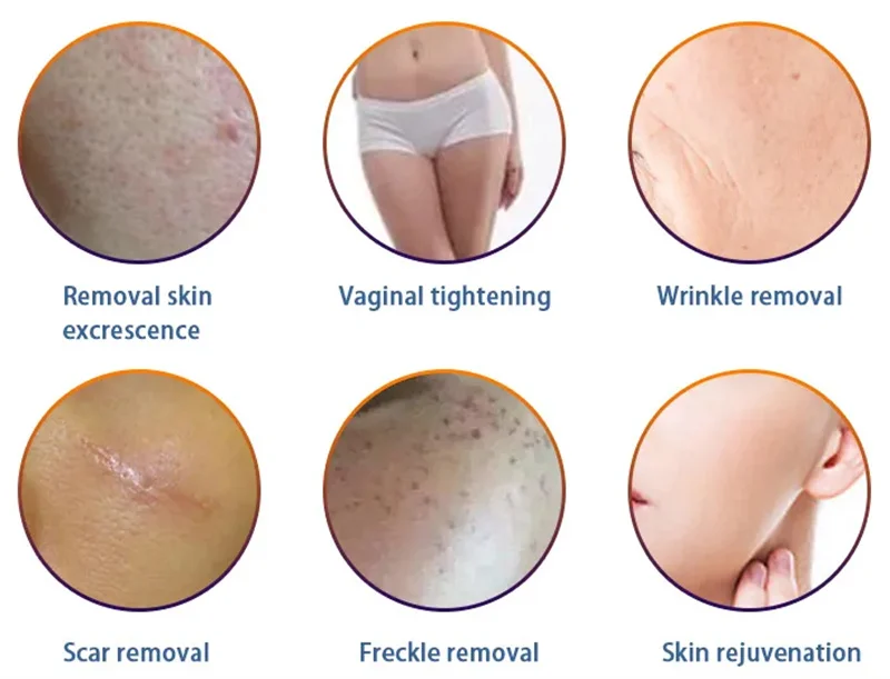 CO2 Laser Scar Removal Skin Resurfacing Fractionally CO2 Laser Vaginal Tightening Machine