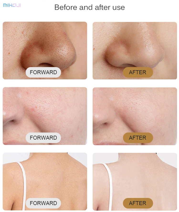 Commercial Hydrafacial Machine with 1 Year Warranty 3 Handles and 220W Working Power for Skin Rejuvenation