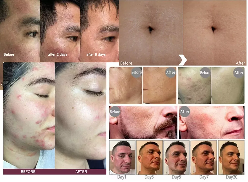 Tixel Heat Therapy Skin Rejuvenation Technology Skin Tightening Fractional Anti-Wrinkle Tixel Home Machine