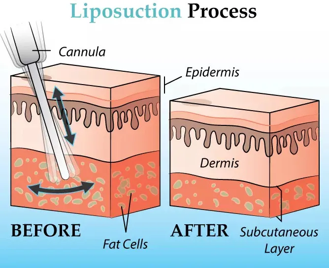 liposuction suction.jpg