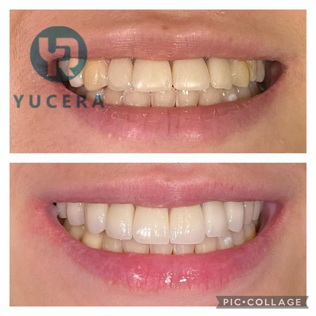 Cad Cam Materials Zirconia Blocks Dental Lab 4d Pro Multilayer for False Teeth