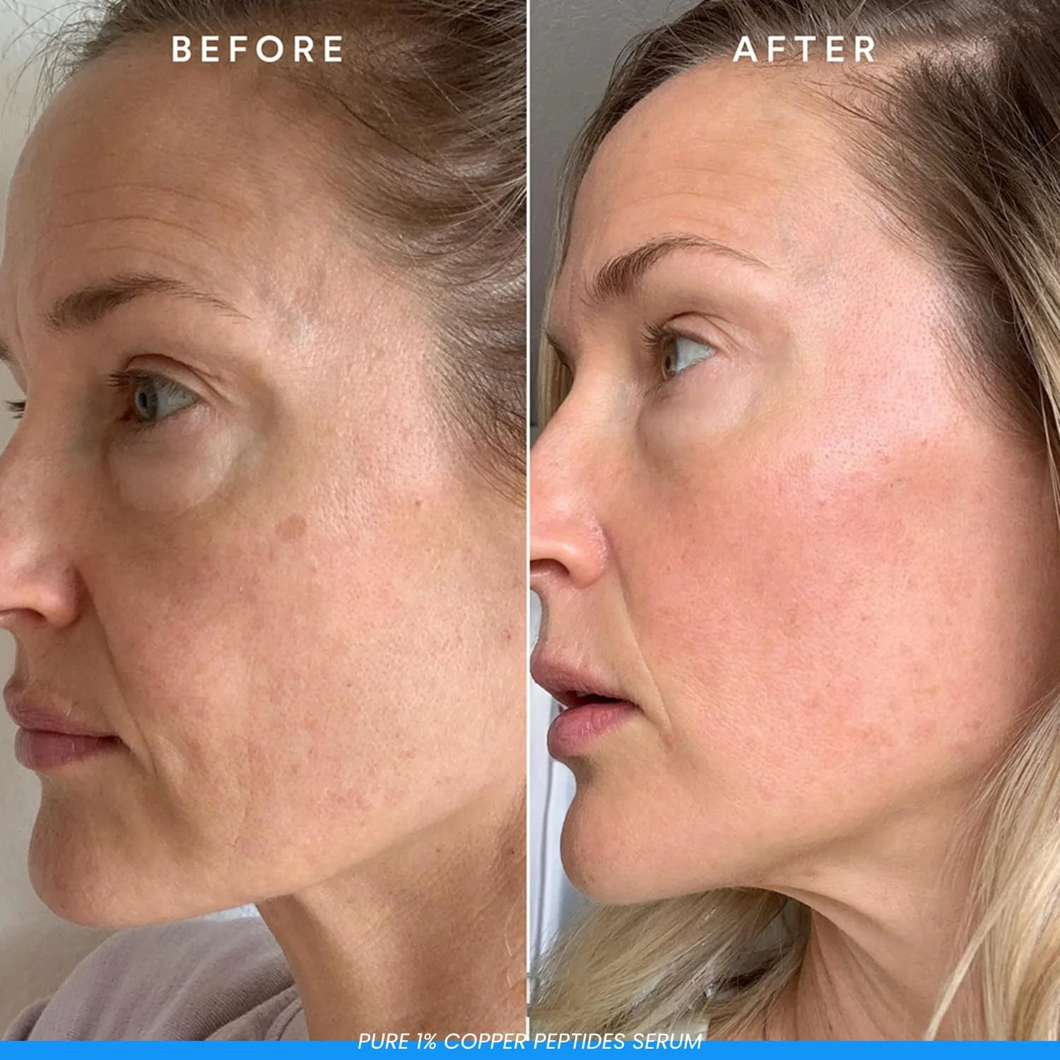 ghk cu before and after acne Squalane + Copper Peptide (GHK-Cu) Rapid Plumping Serum main image 1