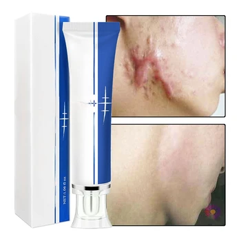 Effective Scar Removal Face Cream Acne Pimples Stretch Marks Remove Gel Smoothing Firming Anti Stretch Marks Scar Repair Cream