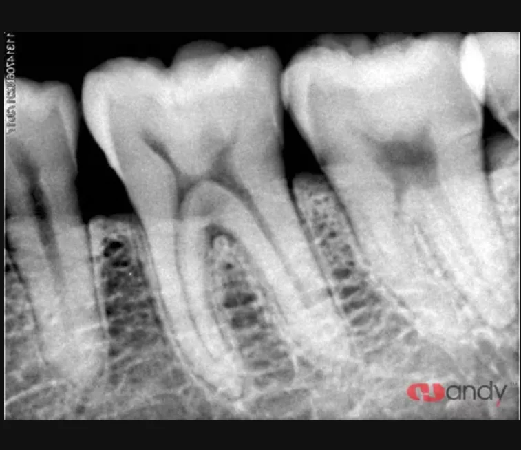 HDR 500A RVG датчик рентгеновского рентгена RVG стоматологический датчик