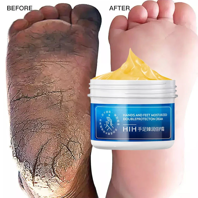 Cracked Heel Repair Vaseline On Heels HIH Dry Skin Hand And Foot