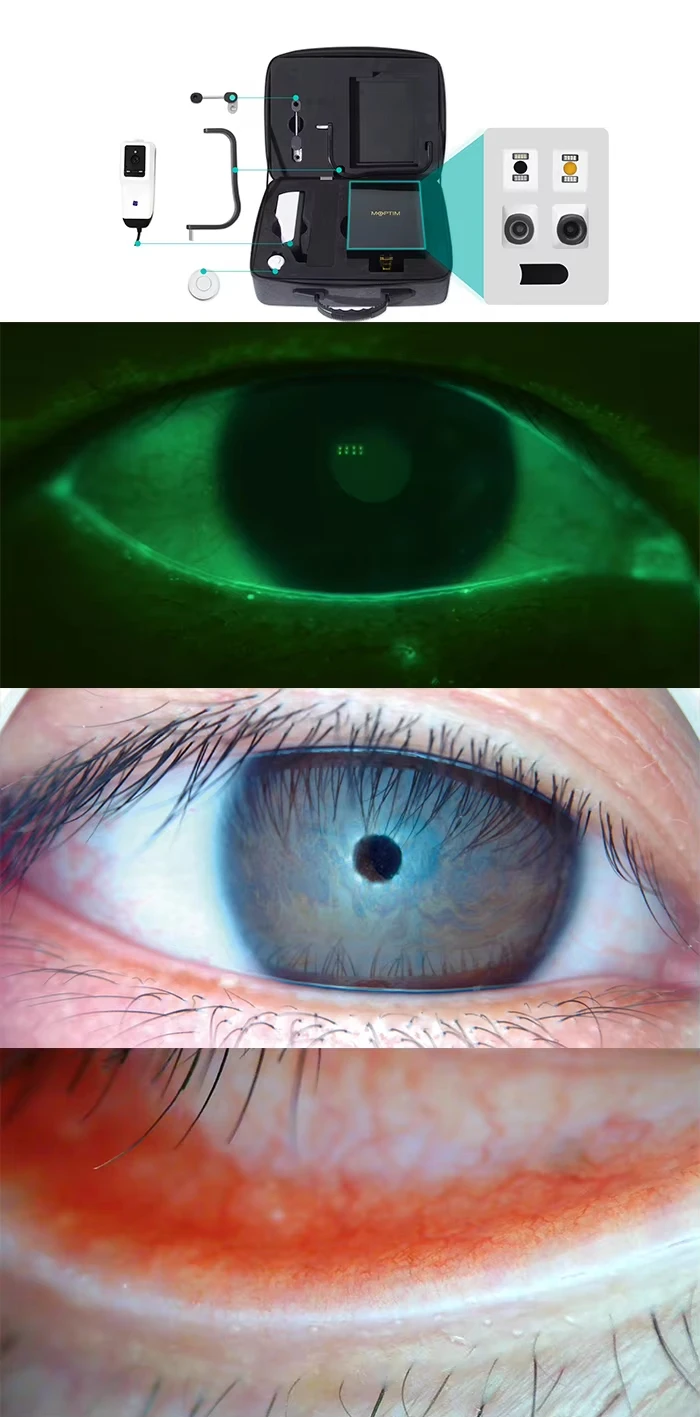 Ophthalmic Dry Eye Analyzer Dry Eye Examination Surface Analyzer Complete Dry Eye Diagnosis