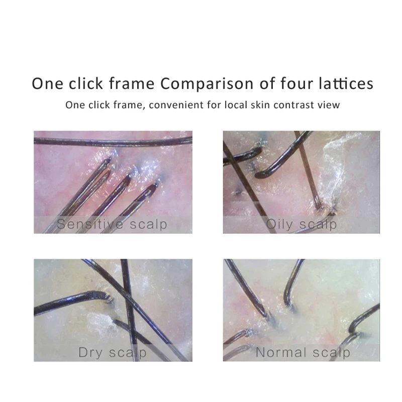 Favourable Price Customized Product Wifh Connection Smart Skin Scalp Hair Detector
