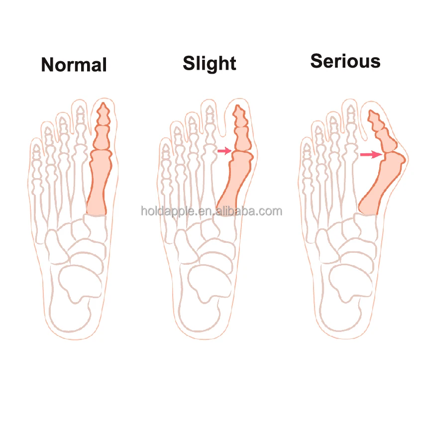 Big Toe Straightener Bunion Relief Splint And Bunion Corrector Splint ...