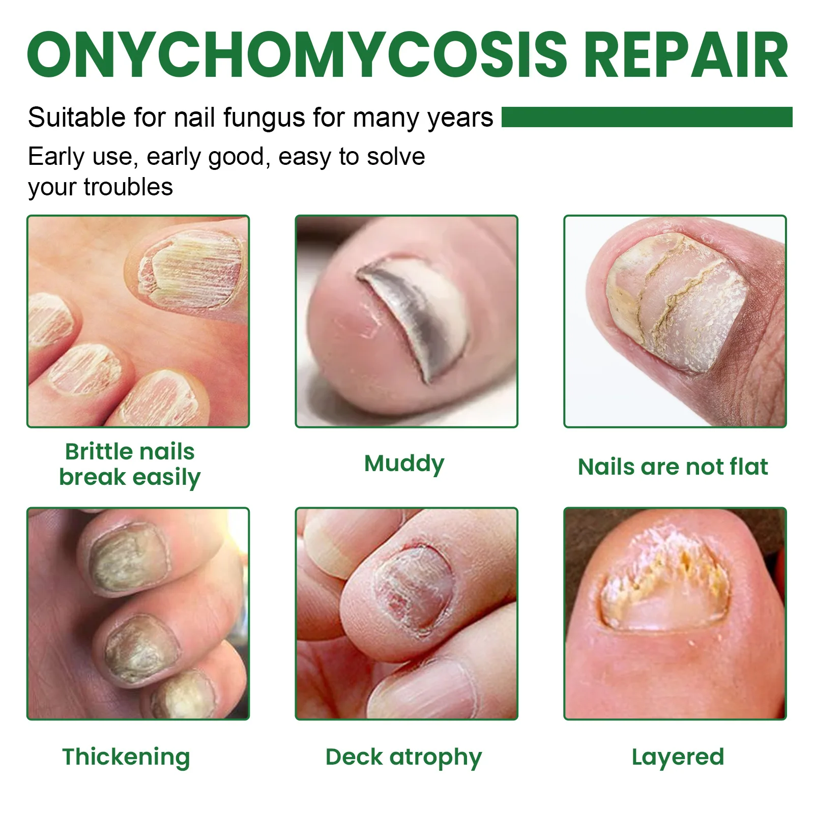 Fungal Nail Infection and Damage on Human Hand. Finger with Onychomycosis,  Disgusting Bitten Fingernails on Man`s Hand Stock Image - Image of damage,  antimycotic: 92516765