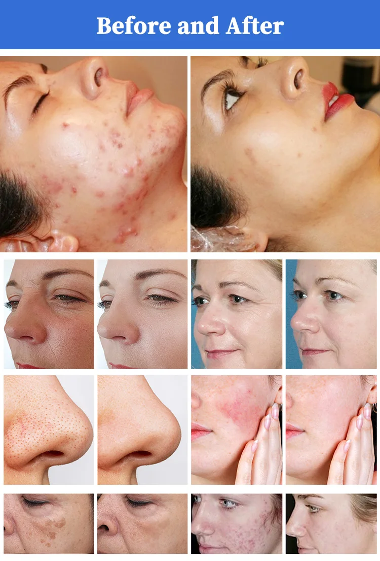 Vertical 12.1-Inch Touch LED Thulium Laser Mask ABS 1927nm Home Care Stimulates Collagen Regeneration Removes Fine Lines