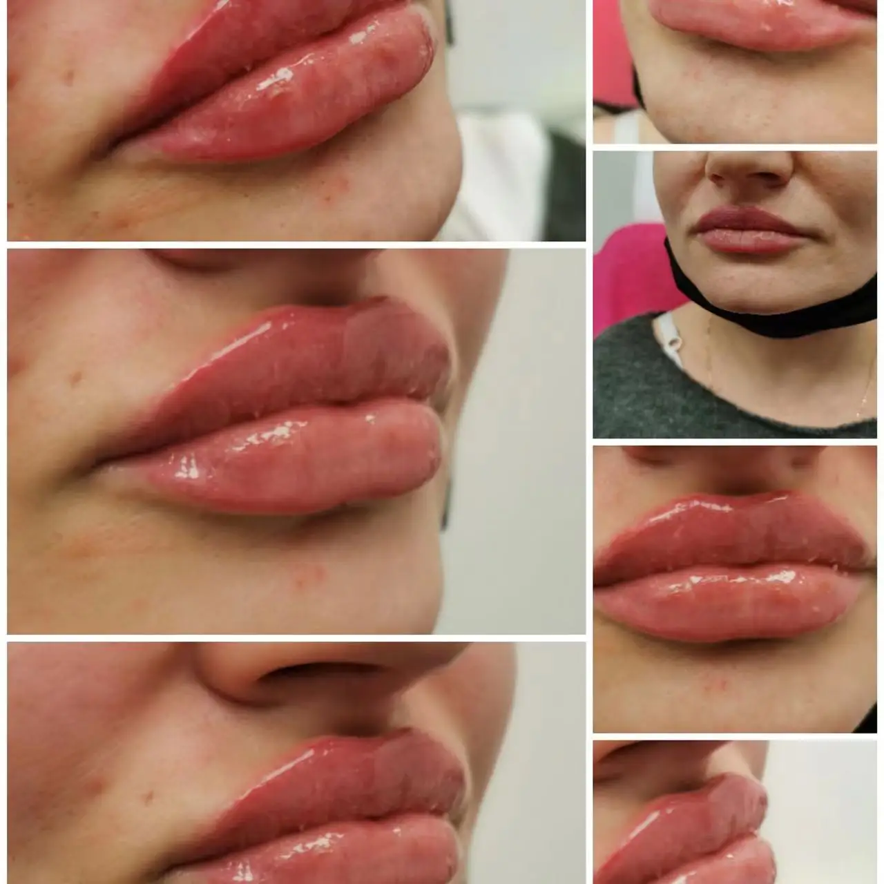 Hereme lips augmentation nose cheek HA gel injection cross-linked hyaluronic acid dermal filler for lip injections