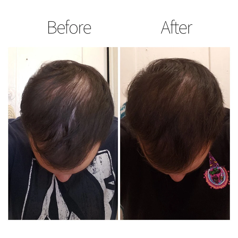 Factory Supply Anti Loss Fast Hair Care Growth Mousse Hair Growth Foam Hair Regrowth Treatment for Men Women