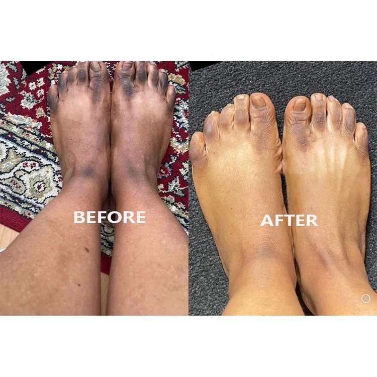 Customized Feet Whitening Cream Fast Results for Dark Spots