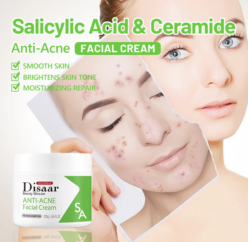 Anti Acne Salicylic Acid Facial Cream Anti Inflammatory Whitening Fade Acne Marks Nicotinamide Face Cream