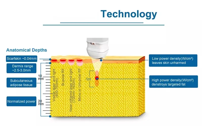 Discover the LipoSonic HIFU Machine for non-invasive fat reduction and body sculpting. Advanced ultrasound technology delivers targeted fat destruction, skin tightening, and visible slimming results for professional clinics and med spas. LipoSonic HIFU Machine for Body Slimming Weight Loss