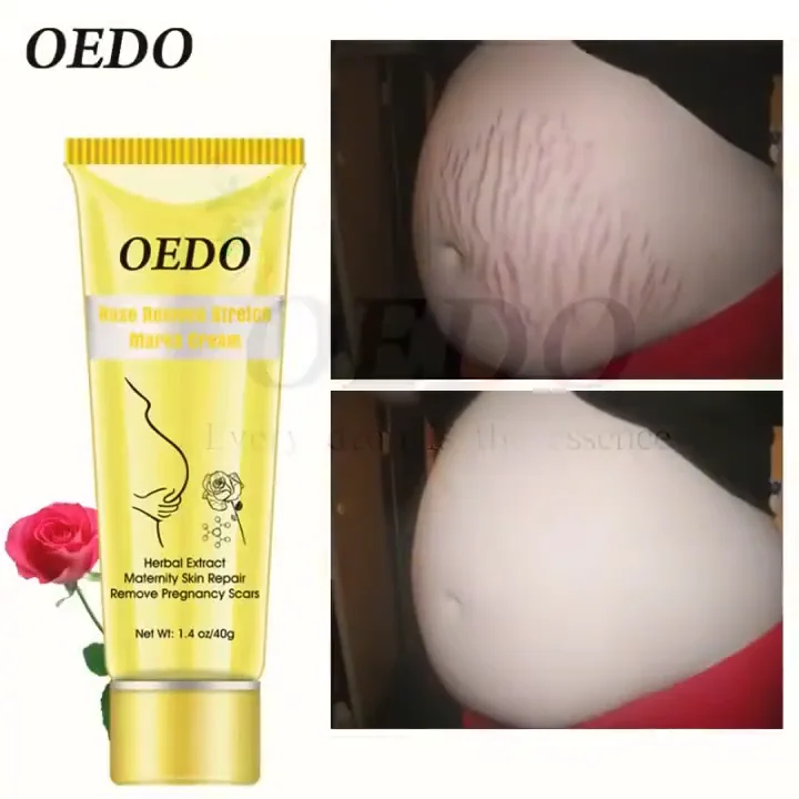 cara menggunakan oedo rose remove stretch mark cream