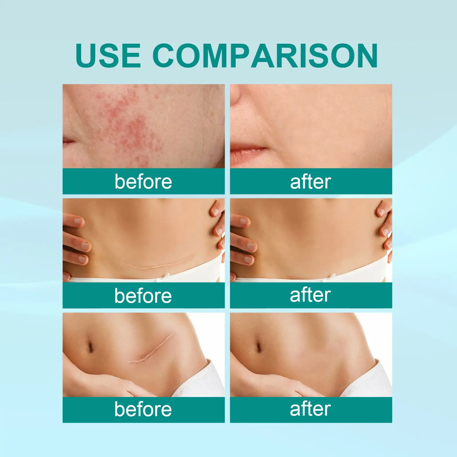 South Moon Scar Spray Cesarean Hyperplastic Contracture Burn Acne Surgical Scars Stretch Mark Keloid Treatment Liquid