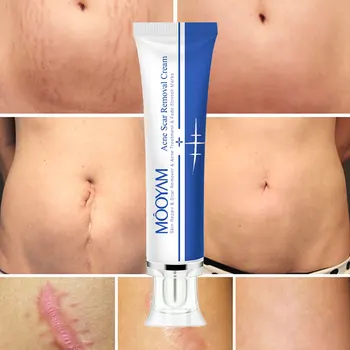 private label Strong Effective Acne Scar Removal Cream Pimples oem Face Gel Tummy Tuck Tightening Stretch Mark Removal Cream