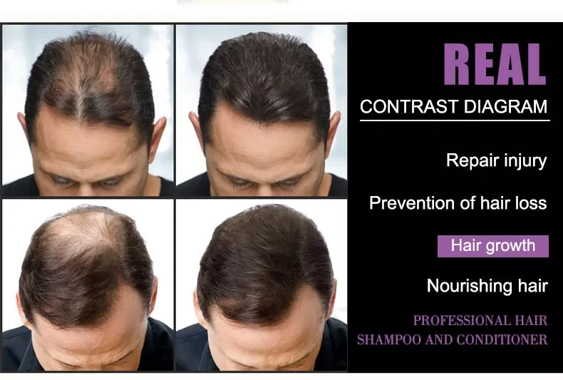 Hot Selling Organic Ginger Hair Growth Shampoo Natural Fast Hair Regrowth Anti Hair Loss Shampoo for Men Women