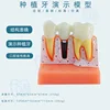 B dental implant white black nail