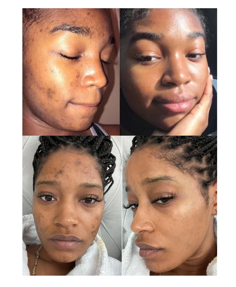 Private Label Natural Salicylic Acid Shrink Pores Remove Acne Scars