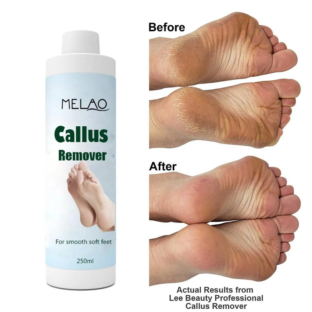 Foot Care Remover Dead Skin Eliminator And Foot Exfoliator Professional Strength Callus Remover Gel