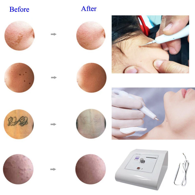 Hot Sale Warts Removal Skin Tag Remover Beauty Instrument Professional Skin Tag Removal Machine