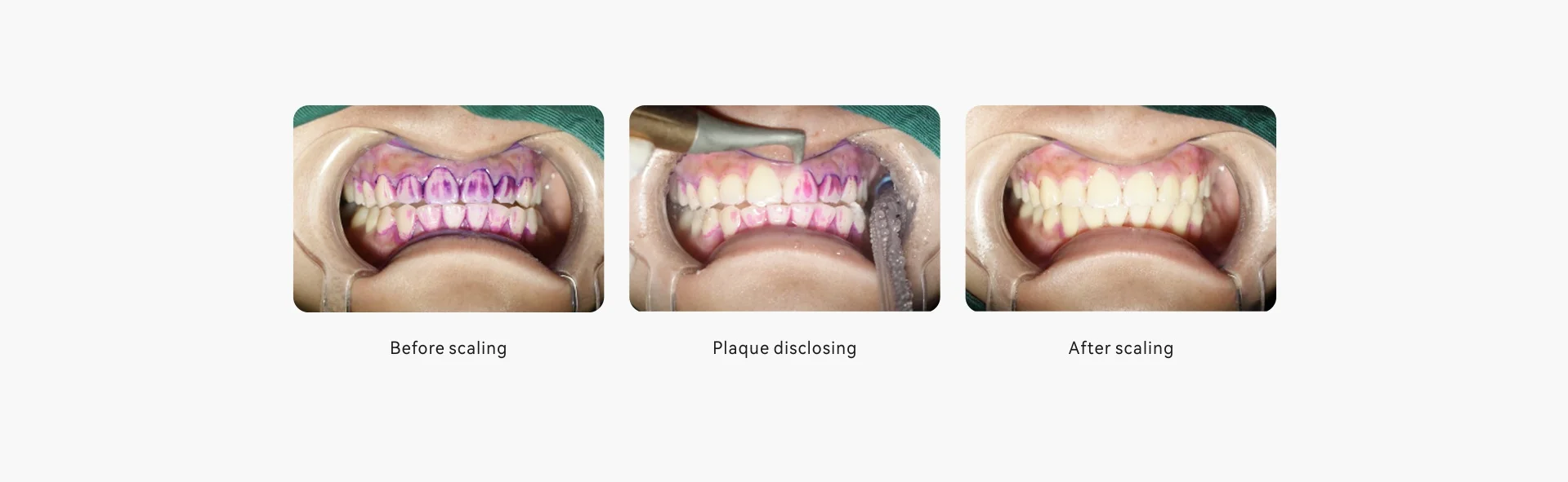 Dental equipment woodpecker air polisher sandblaster / dental air prophy jet for subgingival supragingival