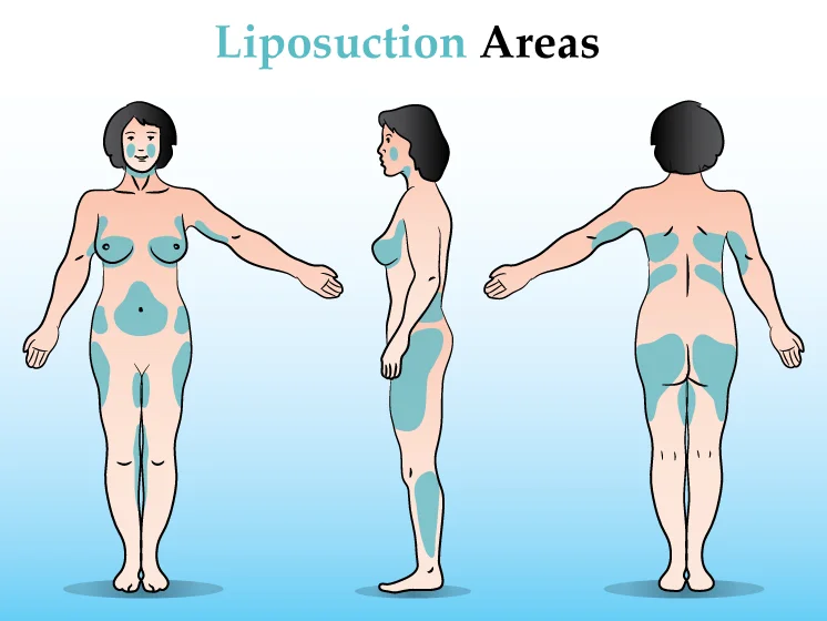 liposuction laser.png