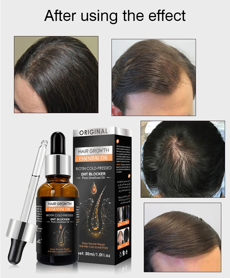 New Original Anti Hair Loss Treatment Fast Hair Growth Serum for Damage Hair