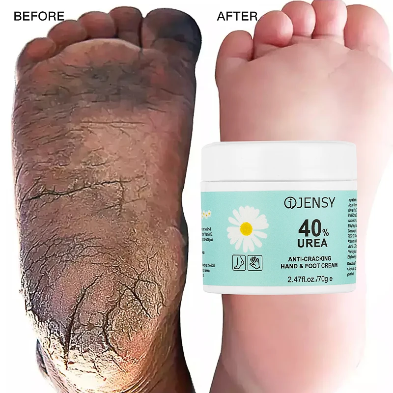 Foot Care Cream for Cracked Heels Exfoliating Anti Crack Peeling Dead Skin  Removal Foot Repair Whitening Urea Foot Cream