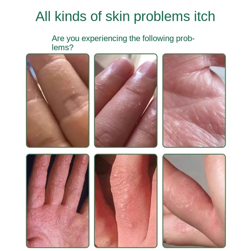 Topical Cream for Skin Sweat Herpes Itching Relief Anti-Ich Hand Foot Cream Chinese Plaster Product Category