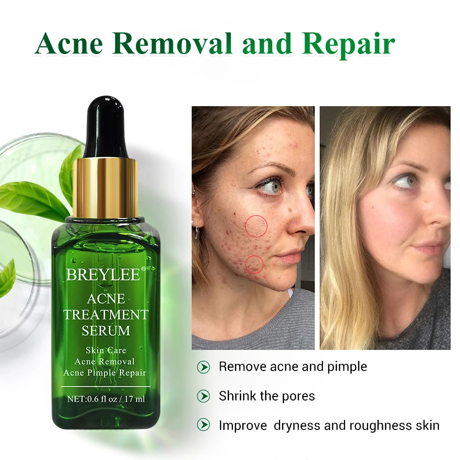 BREYLEE Tea Tree Oil Acne Solution Kit Acne Removal Serum Acne Pimple Repair Cream Moisturize Shrink Pores Face Skin Care Set