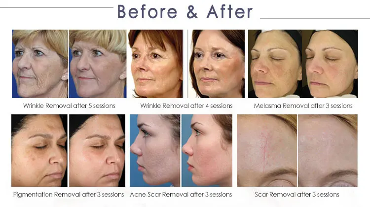 KES RF Tube For Co2 fractional laser machine Scars pimples spots large pores stretch marks Vaginal treatment