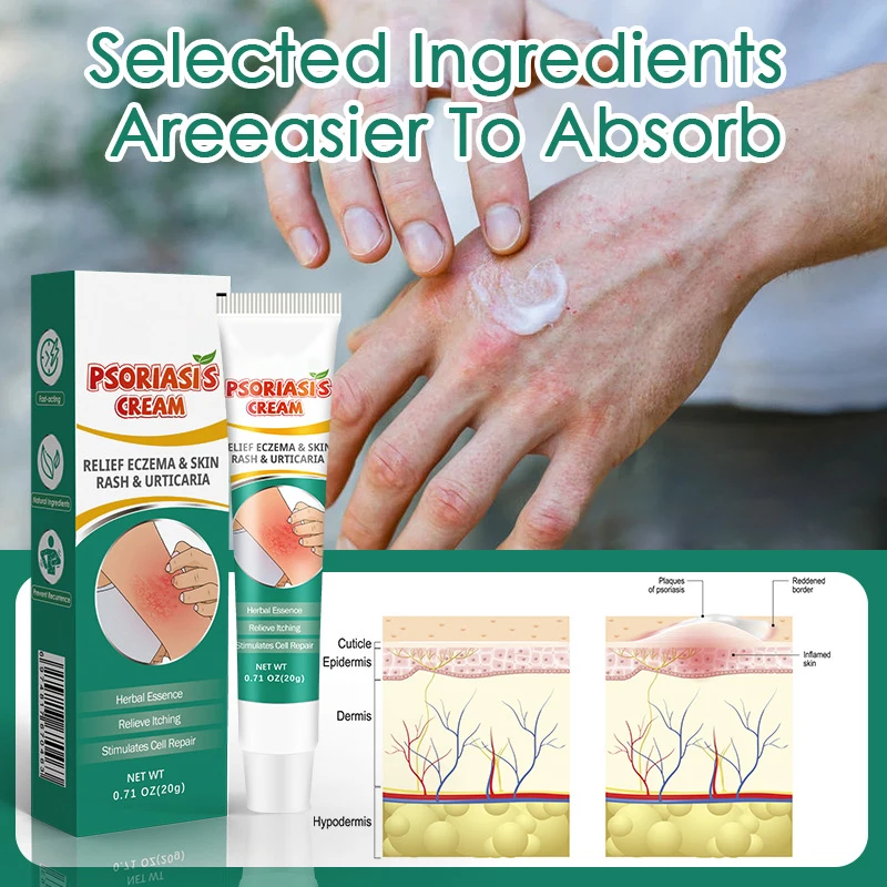 quick effective pure natural chinese herbal dermatitis pruritus psoriasis treatment cream ointment for skin problem